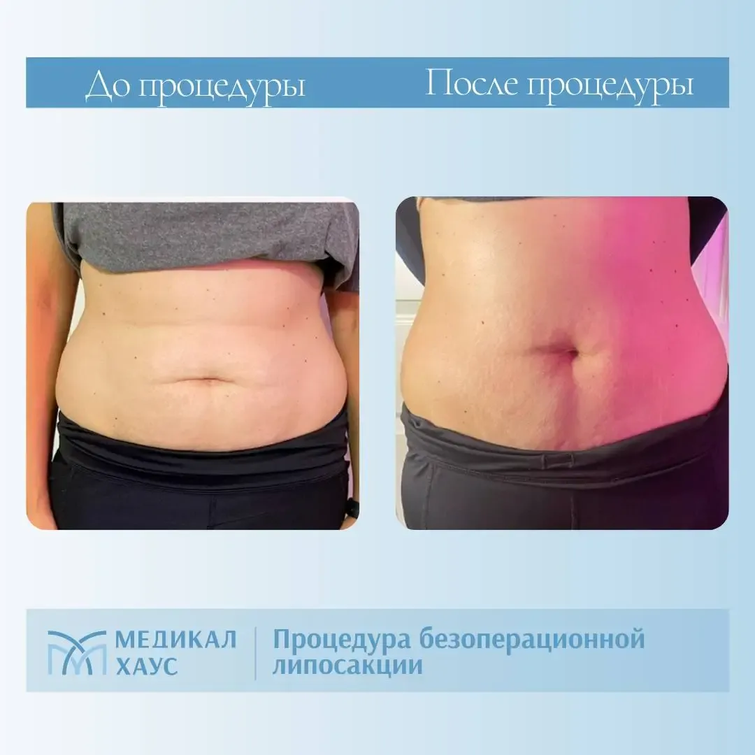 Безоперационная липосакция живота