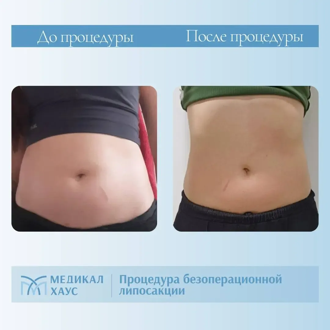 Безоперационная липосакция живота 2