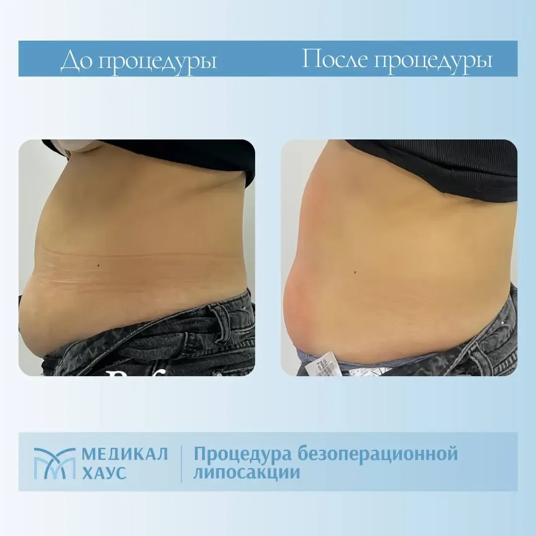 Безоперационная липосакция живота 3