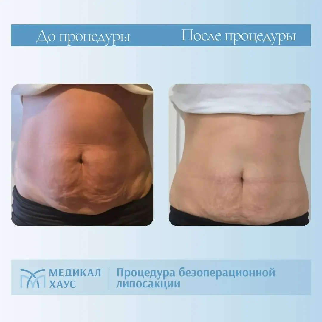 Эффект безоперационной липосакции