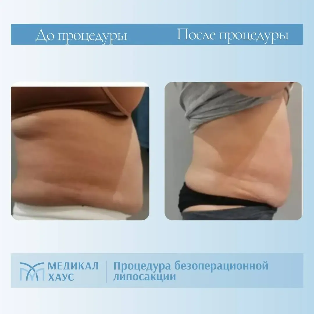 Эффект безоперационной липосакции 2