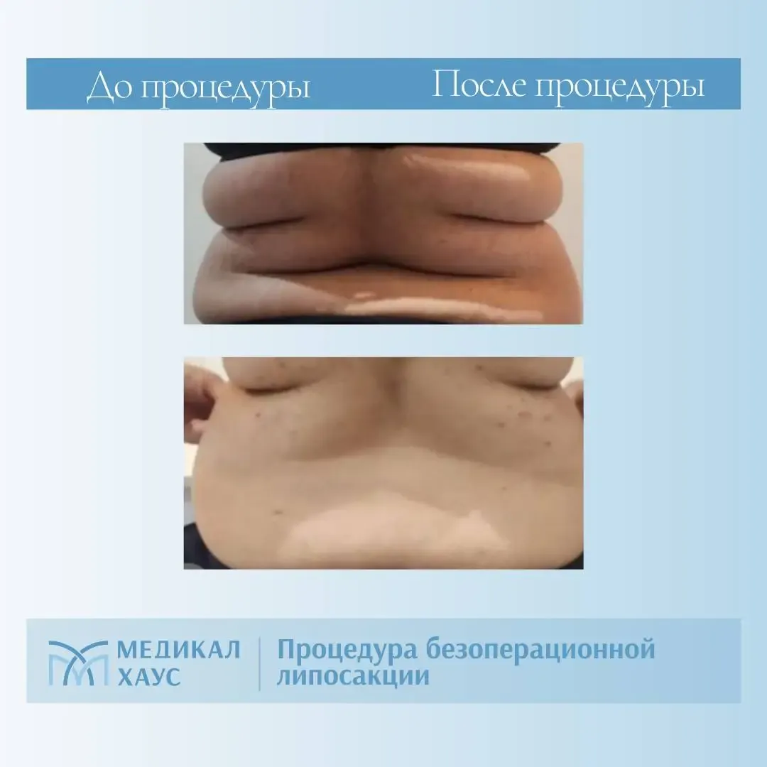 Безоперационная липосакция спины и талии
