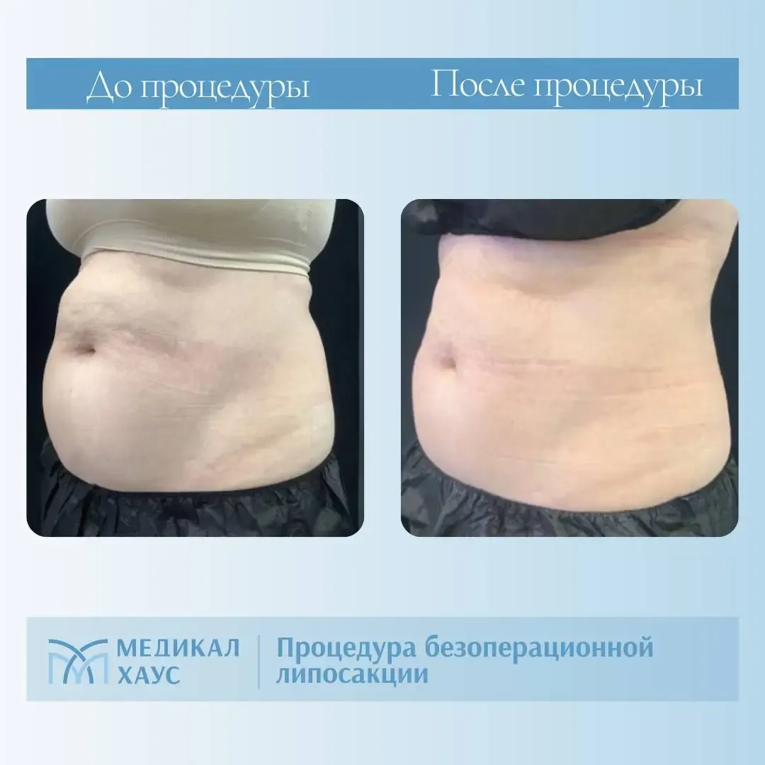 Результат безоперационной липосакции