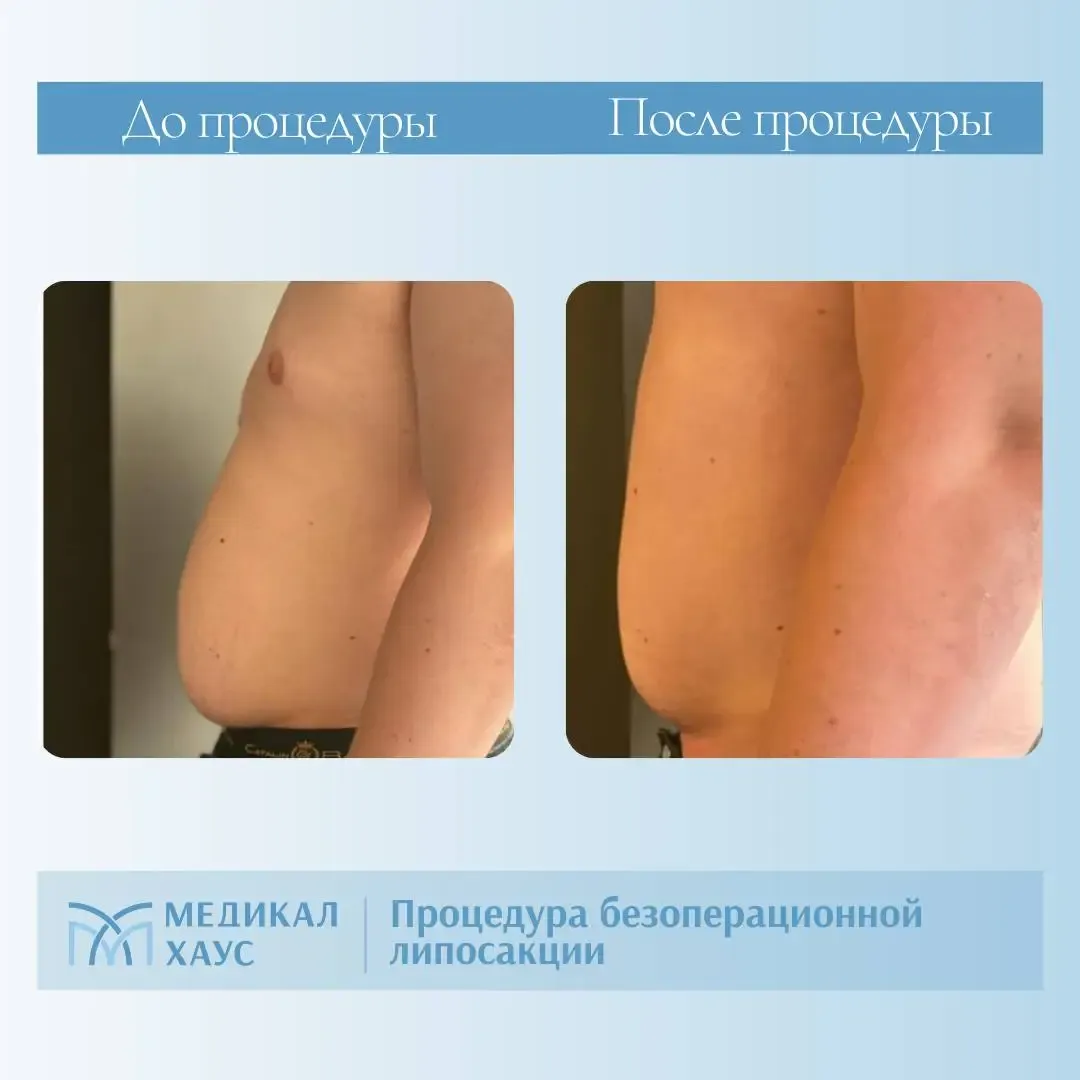 Эффект безоперационной липосакции 3