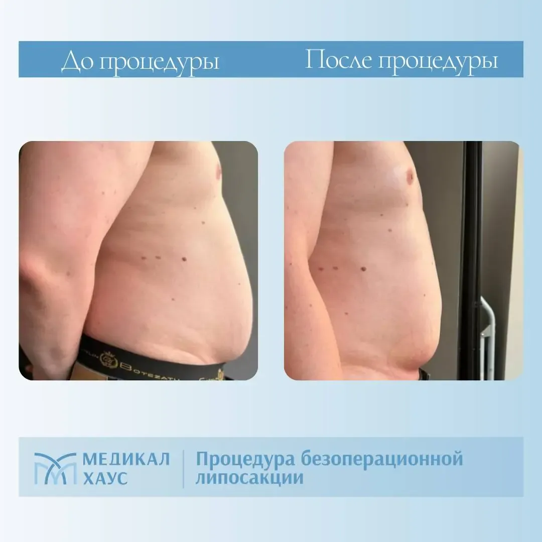 Результат безоперационной липосакции 2