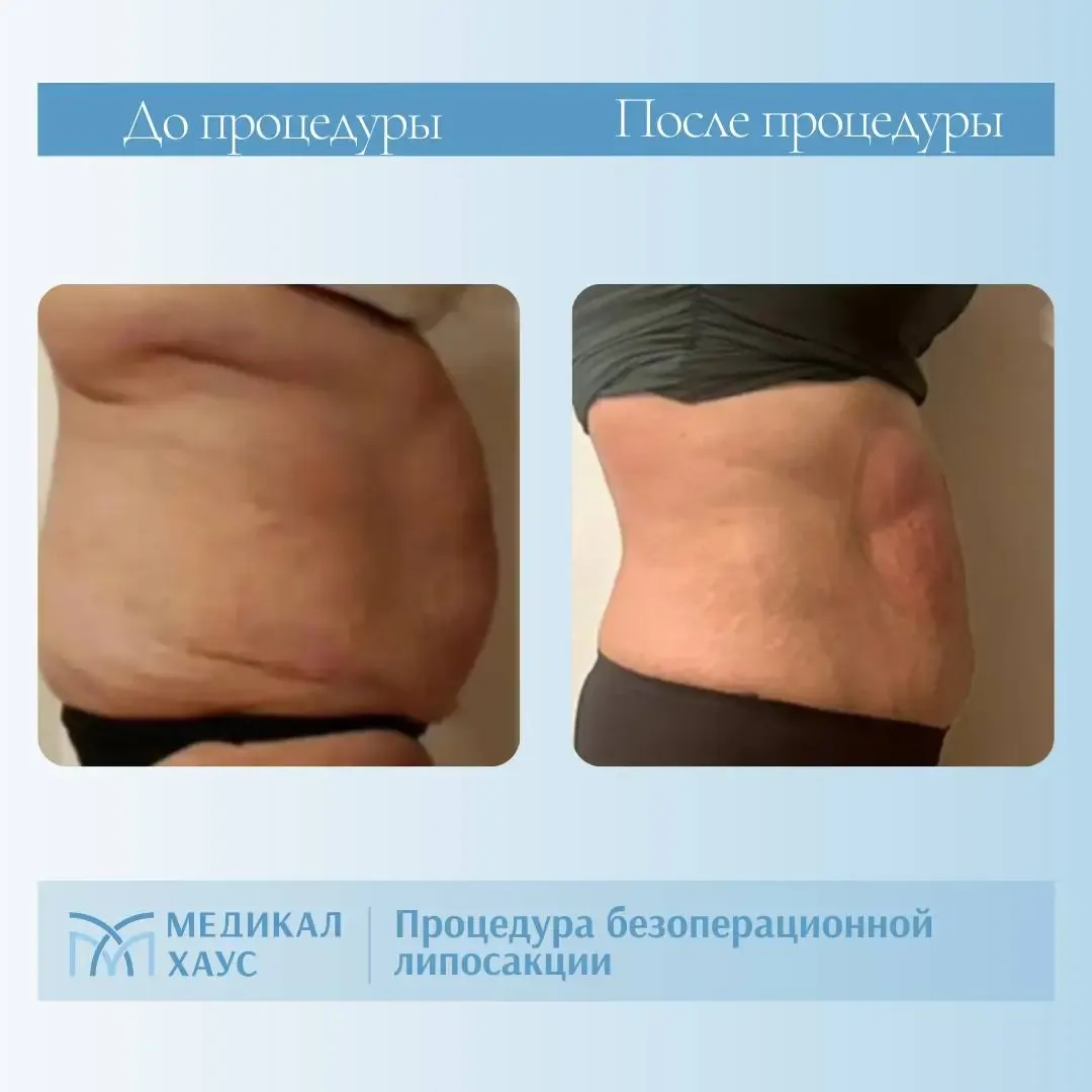 Результат безоперационной липосакции 3