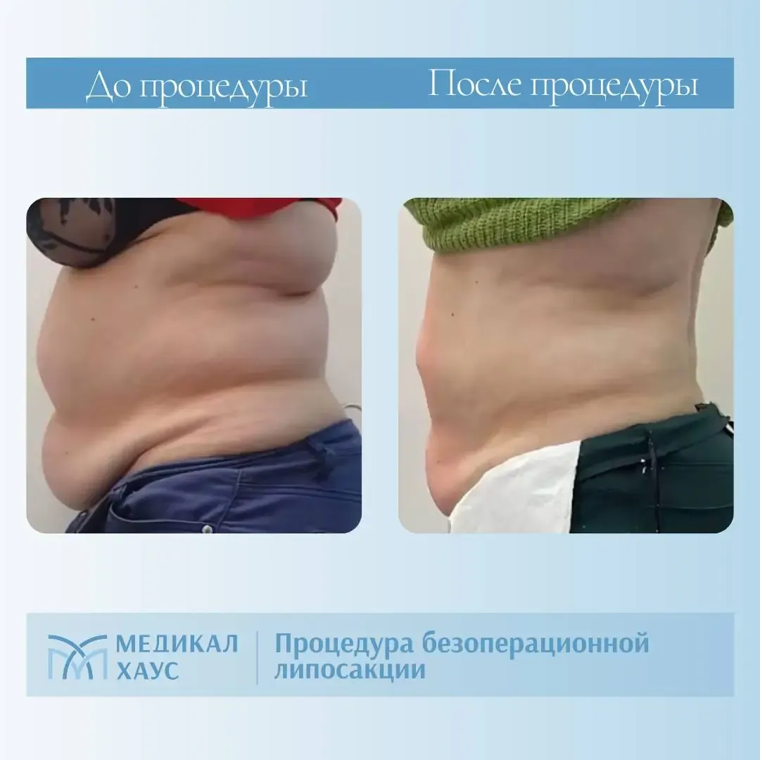 Результат безоперационной липосакции 4