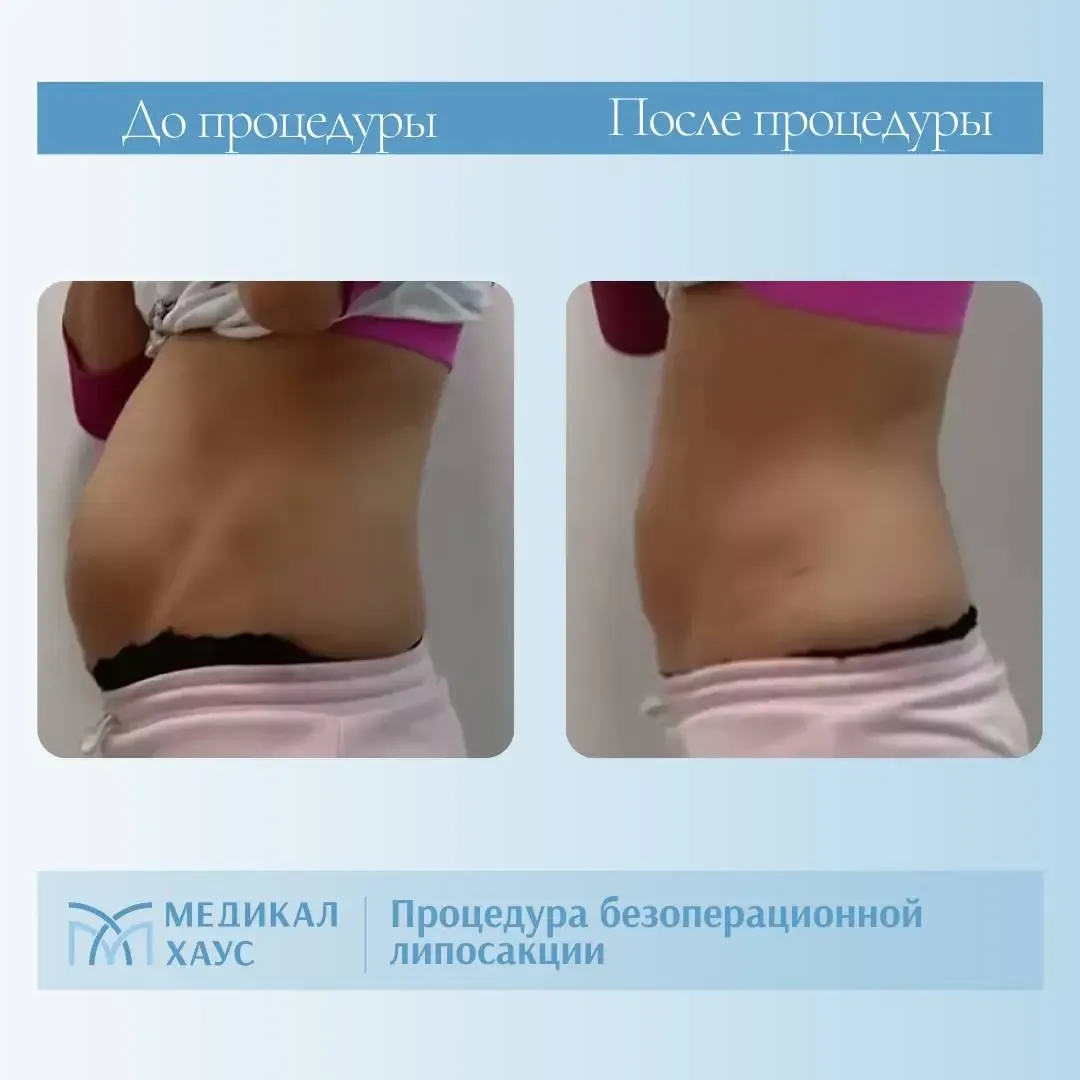 Эффект безоперационной липосакции 4