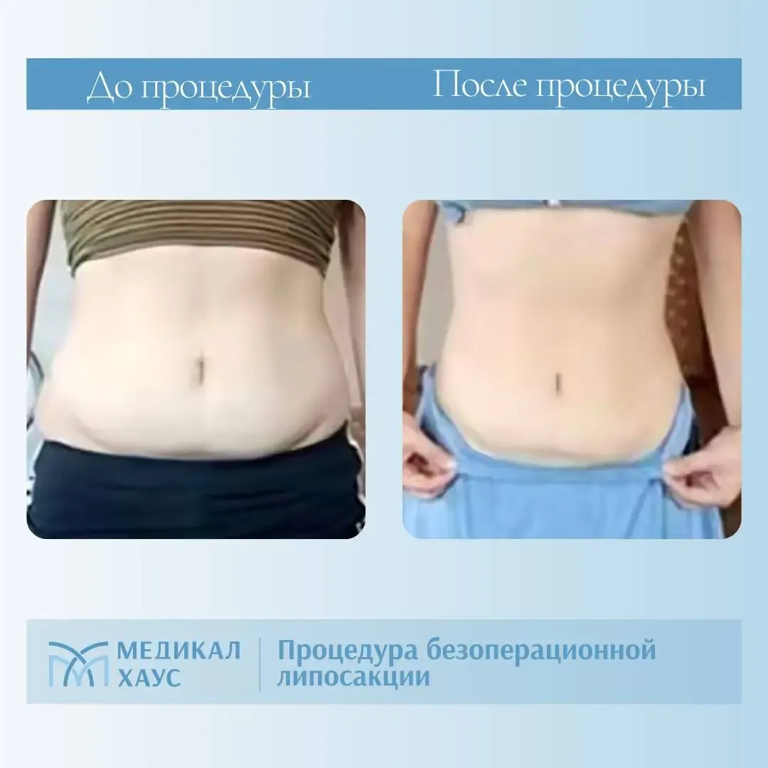 Результат безоперационной липосакции 5