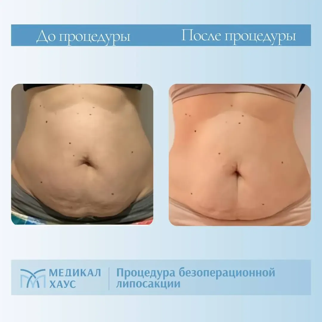 Эффект безоперационной липосакции 5