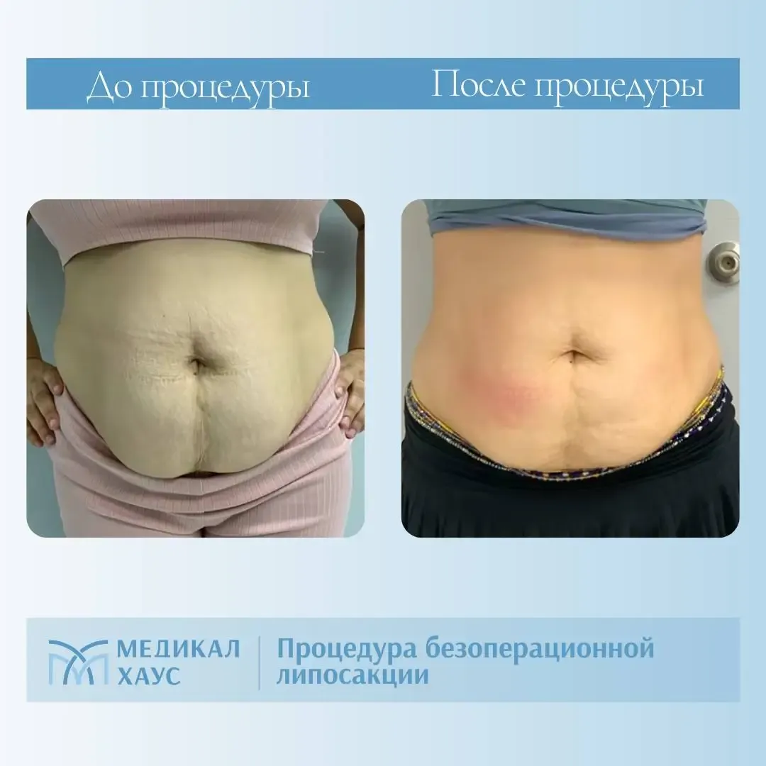 Эффект безоперационной липосакции 6