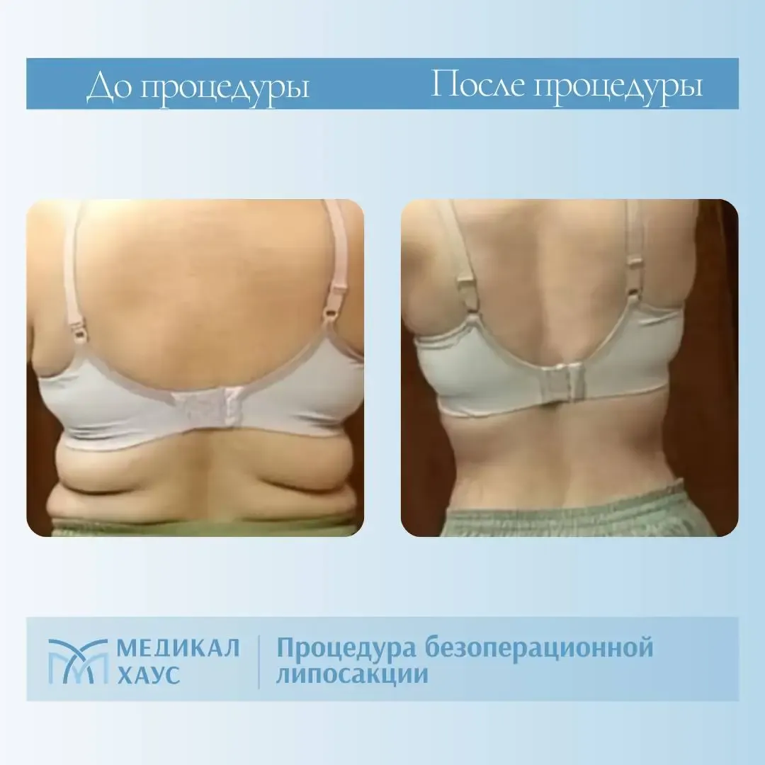 Безоперационная липосакция спины