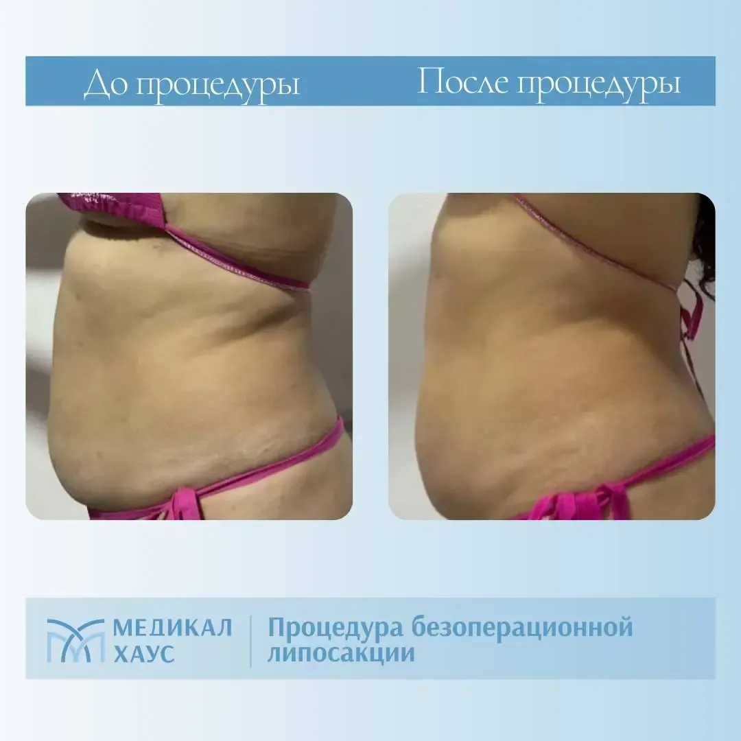 Безоперационная липосакция живота 4