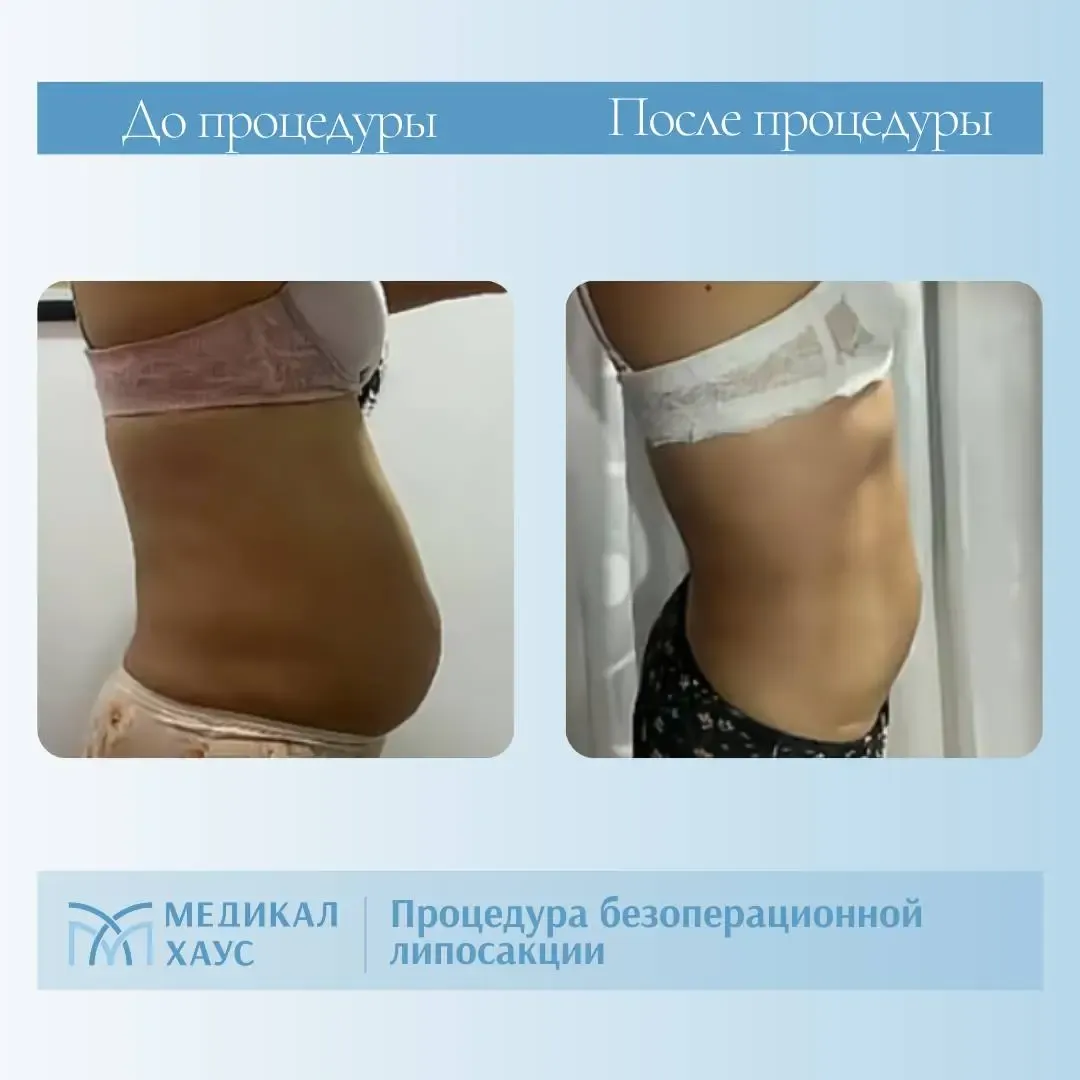 Результат безоперационной липосакции 6