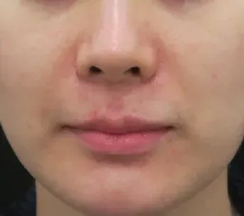 SkinTyte 2