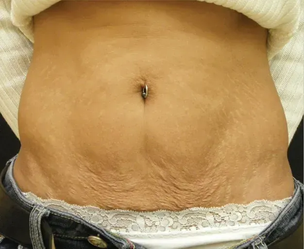 SkinTyte 3