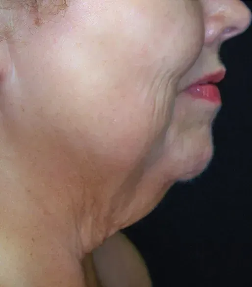 SkinTyte 4