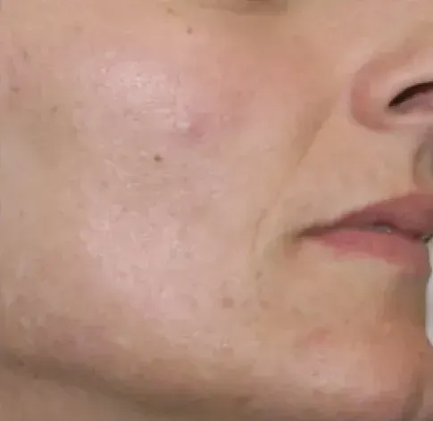 Рубцы 2