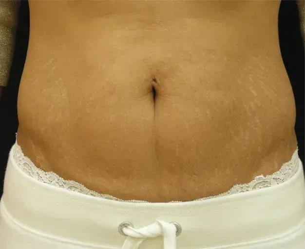 SkinTyte 3