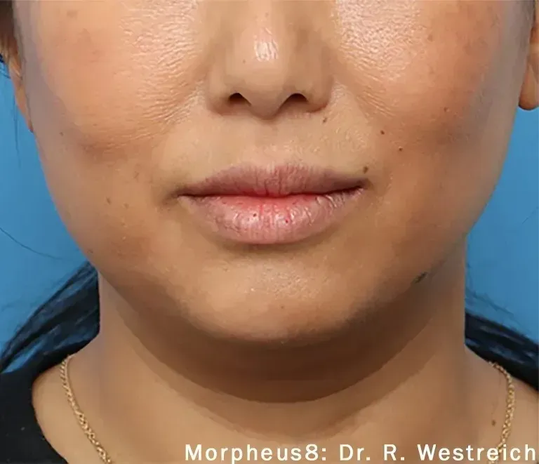 Morpheus8 33