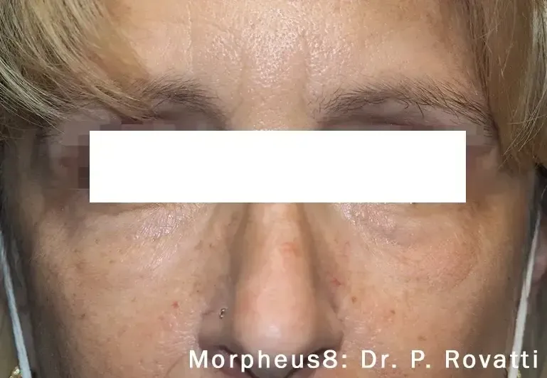 Morpheus8 45