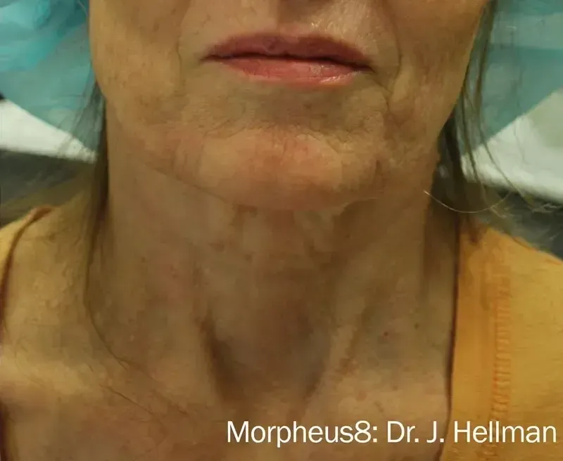 Morpheus8 20