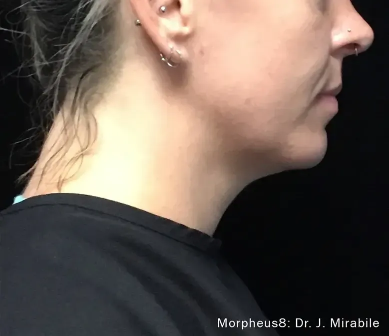 Morpheus8 25