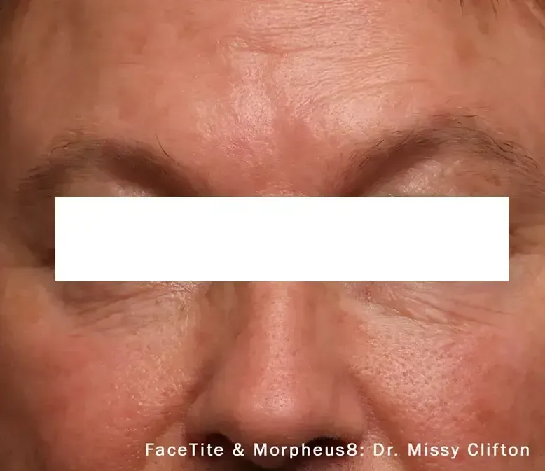 Morpheus8 27
