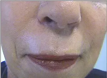 Омоложение 15