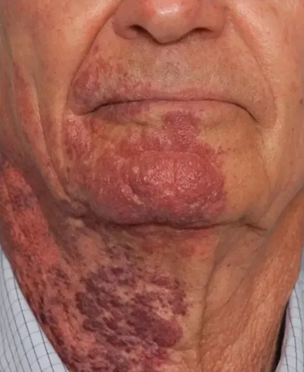 BBL Vascular 1