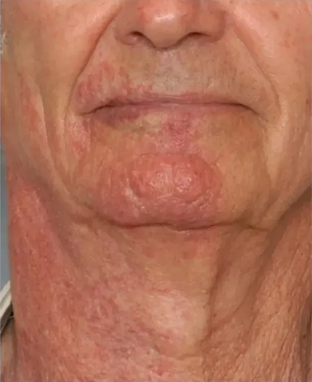 BBL Vascular 1