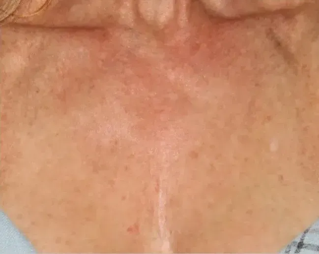 BBL Vascular 11