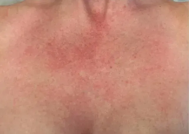 BBL Vascular 12