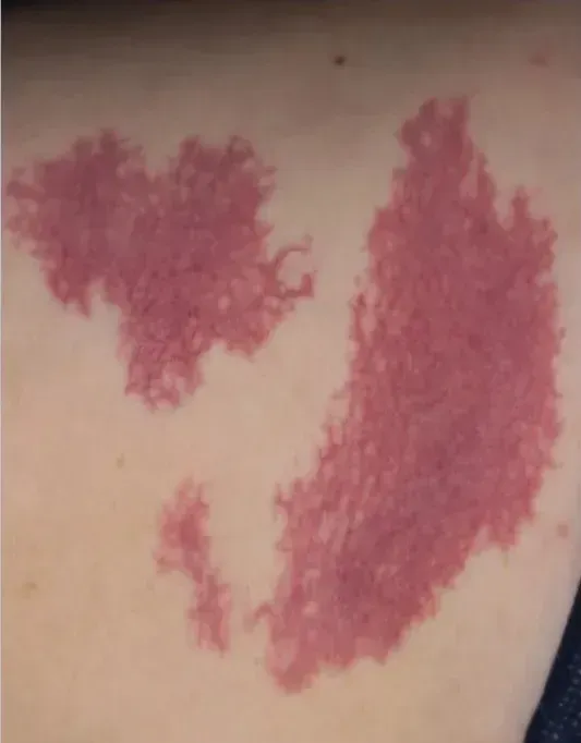 BBL Vascular 4