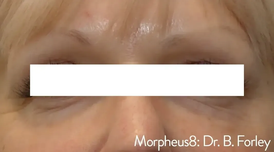 Morpheus8 3