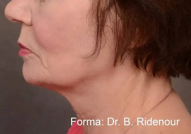 Inmode Forma 5