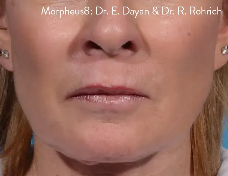 Morpheus8 10
