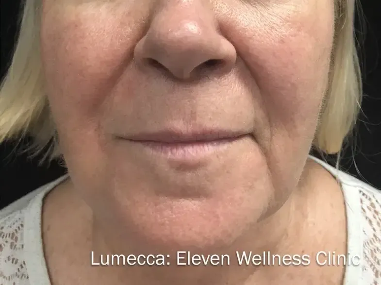 Lumecca 1