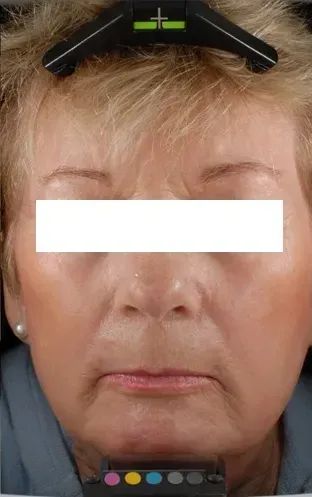 Омоложение 6