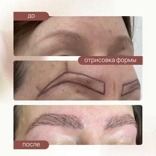 Пересадка бровей 2