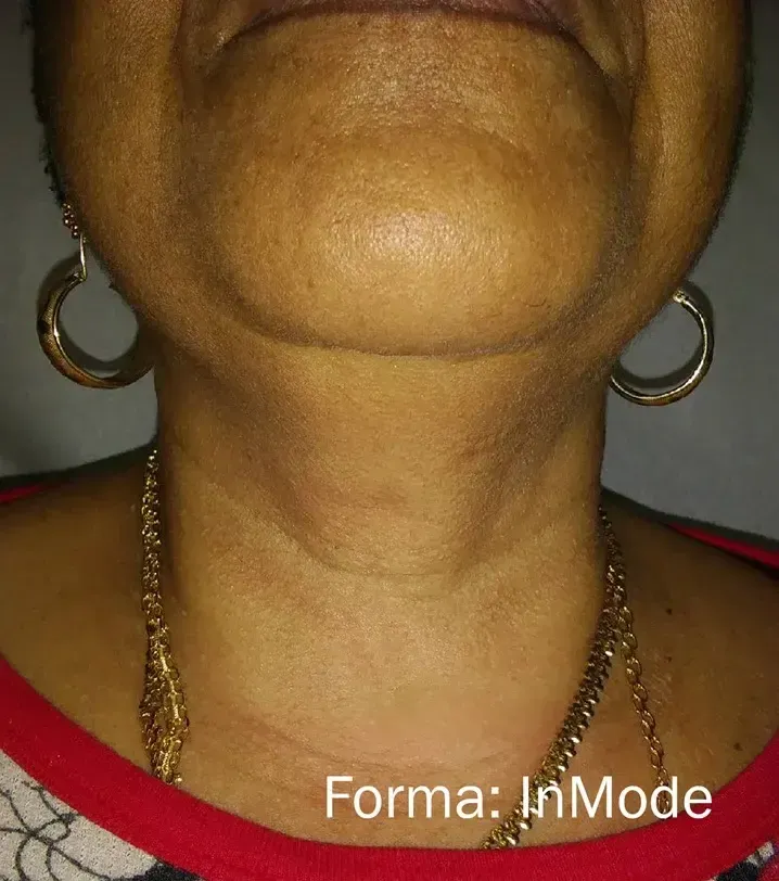 Inmode Forma 9