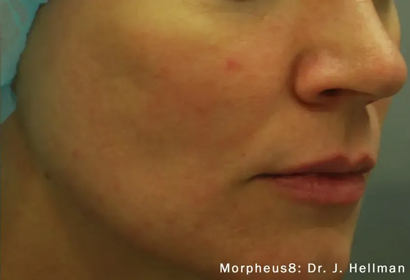 Morpheus8 19