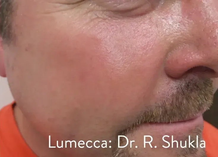 Lumecca 17