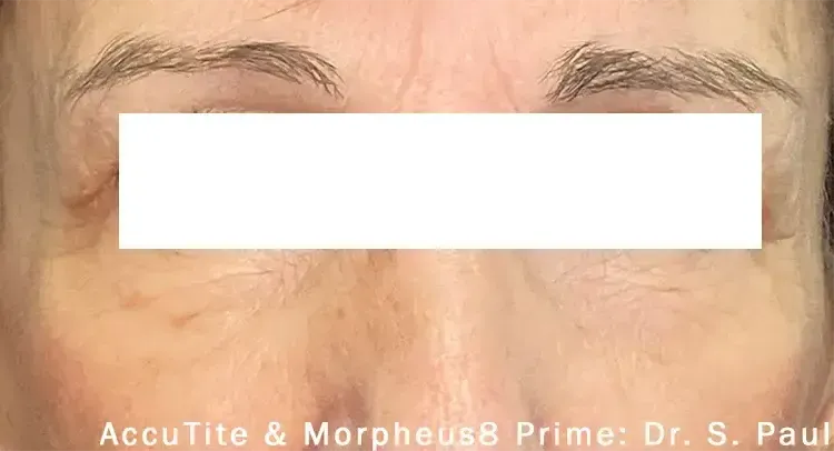 Morpheus8 62