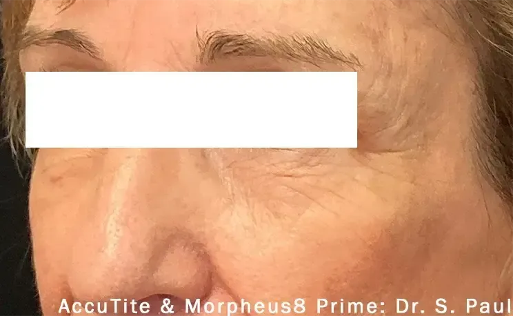 Morpheus8 63