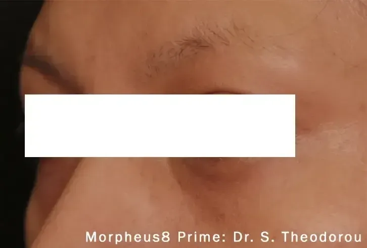 Morpheus8 65