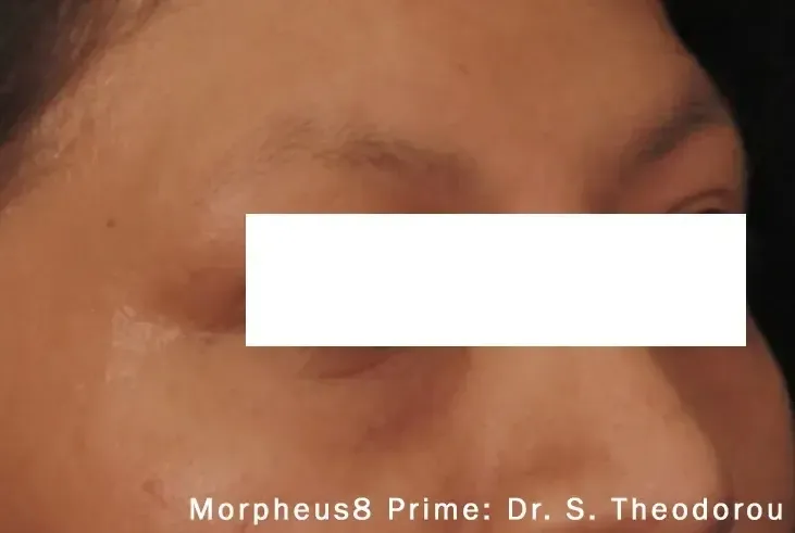 Morpheus8 67