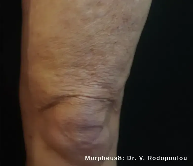 Morpheus8 70