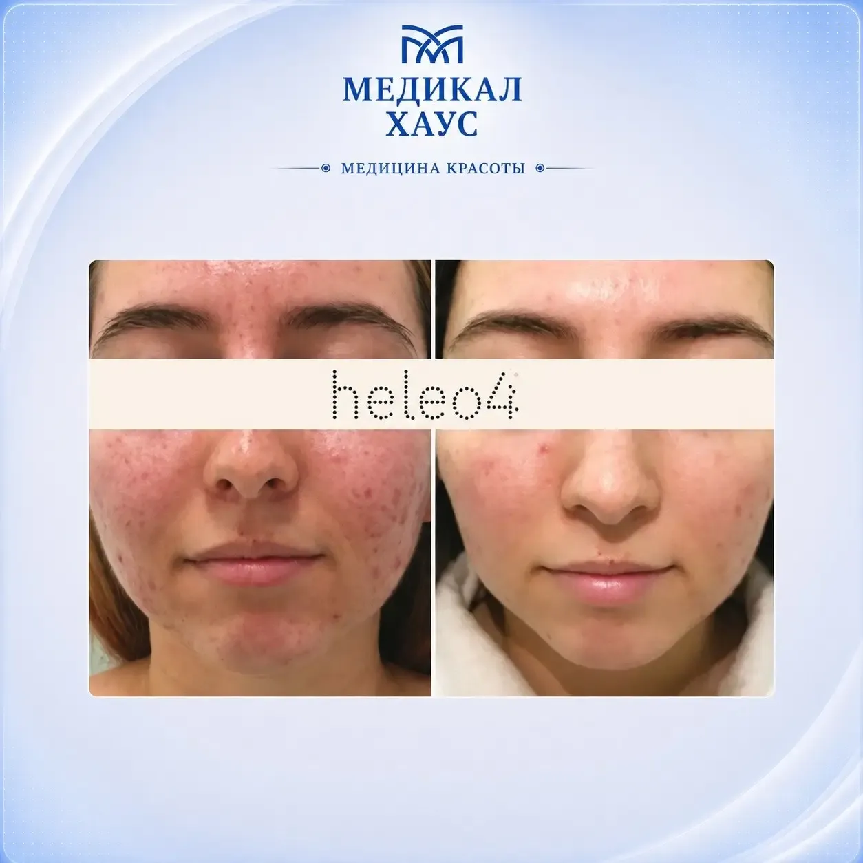 Heleo4