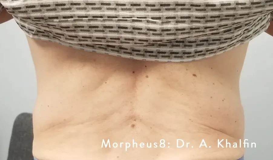 фото после процедуры RF-лифтинга на аппарате Morpheus8